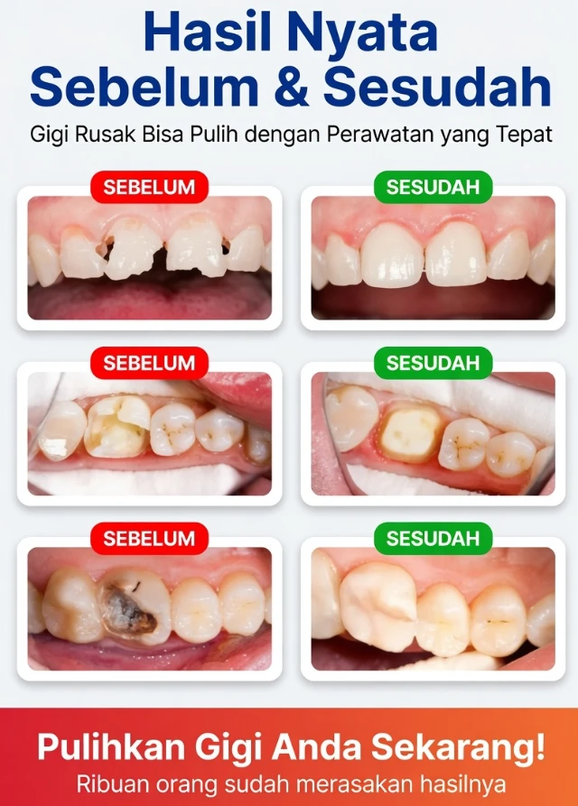 Mencegah Berlubang